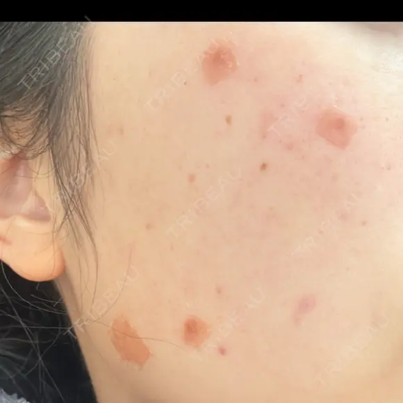 ほくろ・いぼ除去レーザー（肌） 心斎橋KT美容クリニック BEFORE メイン用