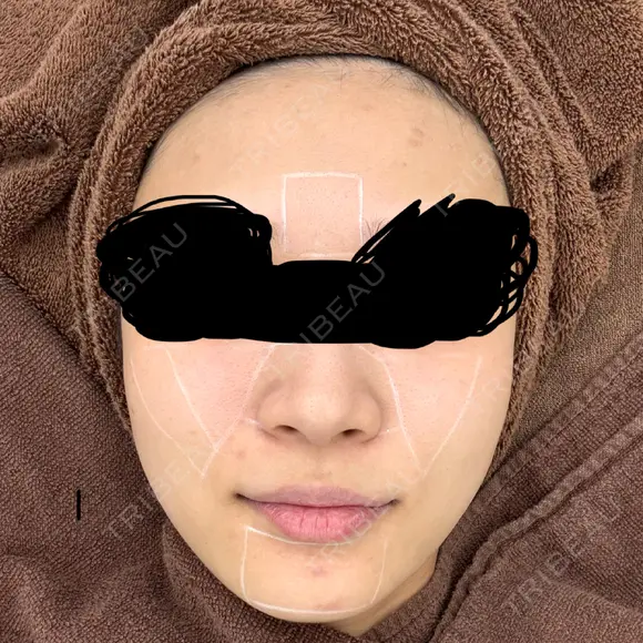 肌育注射（ジュベルックなど） CHARIS BEAUTY CLINIC BEFORE メイン用