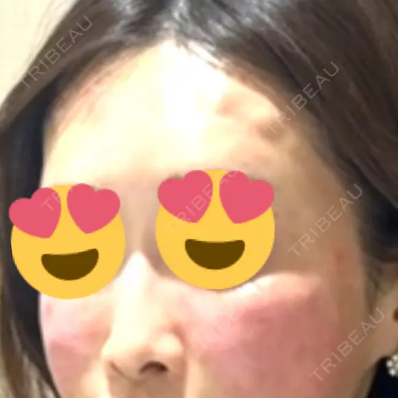 デンシティ Lumiera Clinic BEFORE メイン用