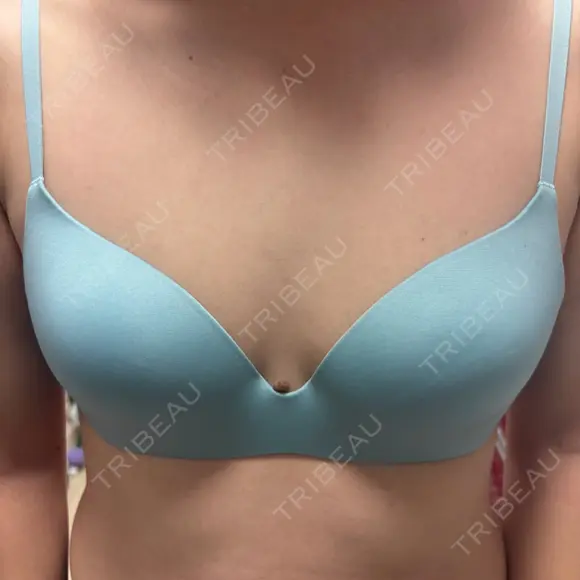 豊胸（シリコン＋脂肪併用） さくらバストクリニック BEFORE メイン用