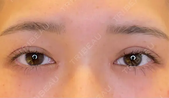 目尻切開 / タレ目形成・グラマラスライン（埋没） LOUIS CLINIC 二子玉川院【ルイクリニック】 BEFORE メイン用