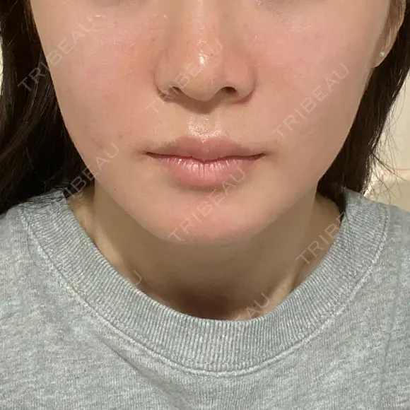 ヒアルロン酸注入（頬） / ヒアルロン酸注入（鼻翼基部） KIMI CLINIC 形成・美容外科 BEFORE メイン用