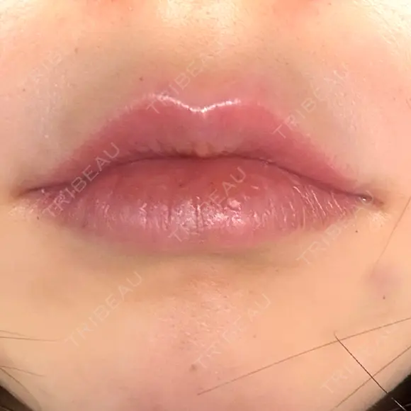 ヒアルロン酸注入（唇） HAAB×DREAM BEAUTY CLINIC 大阪梅田院 BEFORE メイン用
