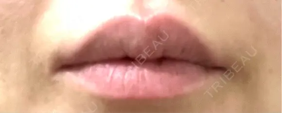 ヒアルロン酸注入（涙袋） / ヒアルロン酸注入（唇） / ボトックス（肩） / ボトックス（首） / シミ取りレーザー ルヴィクリニック イオンドーム前院 BEFORE メイン用