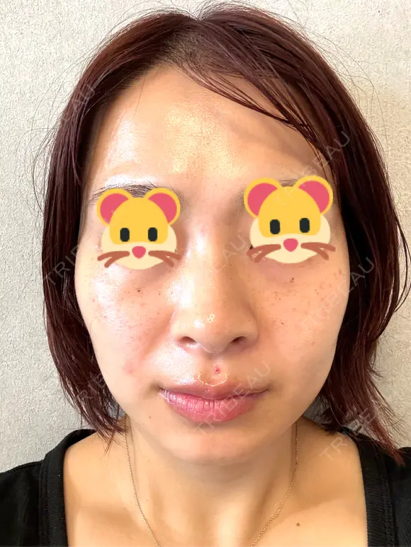 ボトックス（エラ・小顔） / ルメッカ ルラ美容クリニック 横浜院 BEFORE メイン用