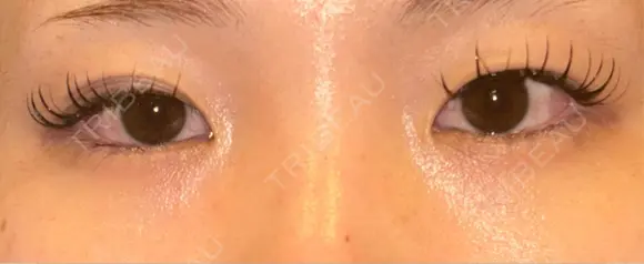 二重埋没 / 目頭切開 湘南美容クリニック 千葉センシティ院 BEFORE メイン用