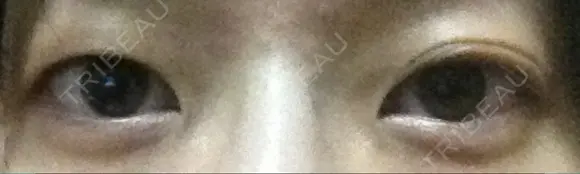 二重埋没 ライフクリニック BEFORE メイン用