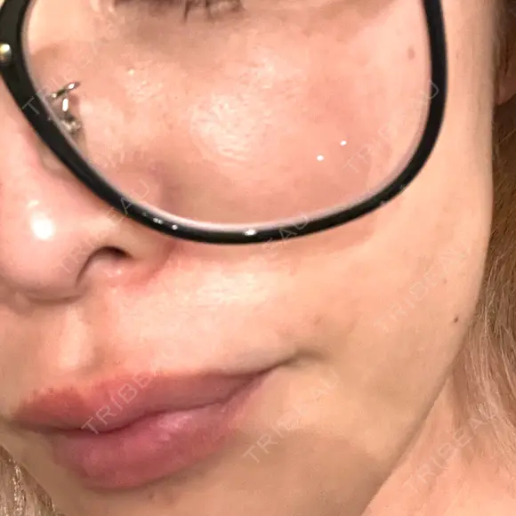 ピコレーザートーニング（美白・肝斑） / ピコフラクショナルレーザー（毛穴・ニキビ跡） しんゆり美容健康クリニック BEFORE メイン用