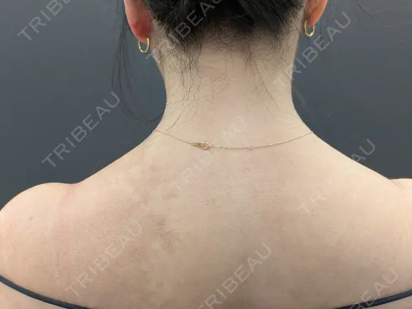 ボトックス（肩） eクリニック 横浜みなとみらい院 BEFORE メイン用