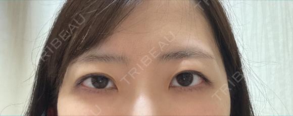 二重切開 / 目頭切開 / 眼瞼下垂（切開） LUHO（ルホ）美容外科 BEFORE メイン用