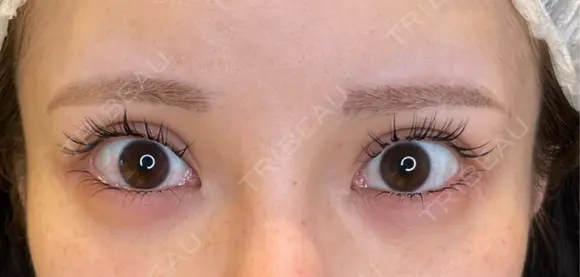 目尻切開 / タレ目形成・グラマラスライン（埋没） LOUIS CLINIC 二子玉川院【ルイクリニック】 BEFORE メイン用