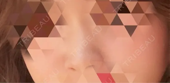 隆鼻術 形成外科と美容外科のクリニック池袋 BEFORE メイン用