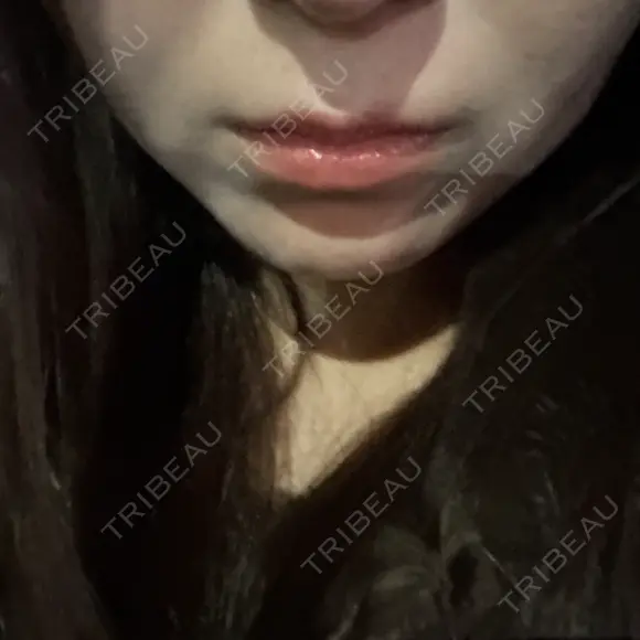 オンダリフト RIVER CLINIC（リバークリニック） BEFORE メイン用