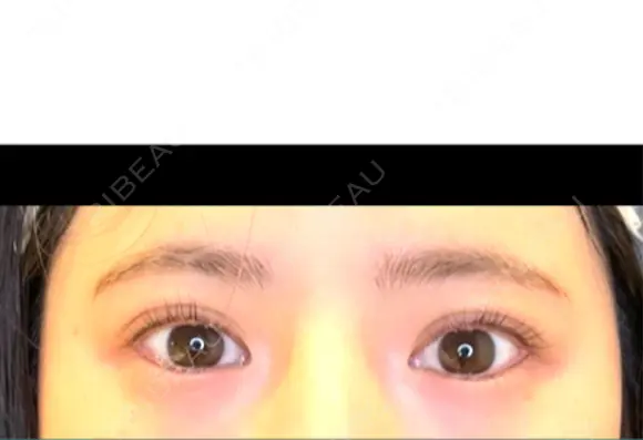 目尻切開 / タレ目形成・グラマラスライン（埋没） LOUIS CLINIC 二子玉川院【ルイクリニック】 BEFORE メイン用