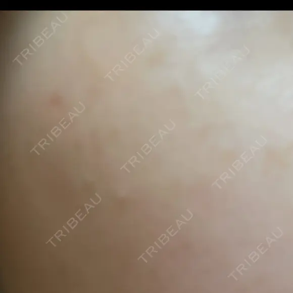 光治療（フォトフェイシャルなど） アクティブエイジクリニック BEFORE メイン用