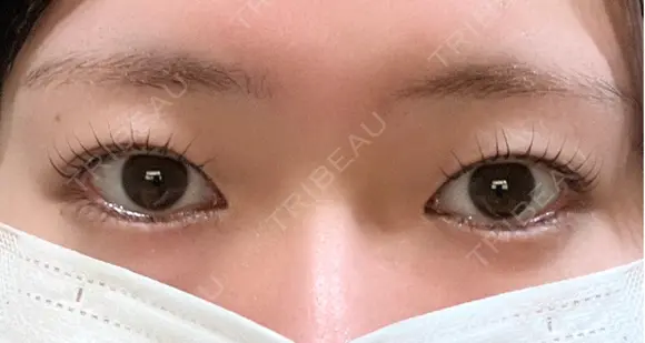 二重埋没 EMMA CLINIC（エマクリニック） BEFORE メイン用