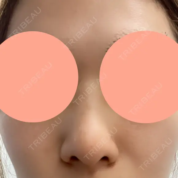 ヒアルロン酸注入（鼻） 博多美容外科/美容皮膚科 ビラビューティークリニック BEFORE メイン用