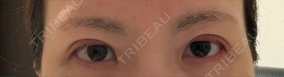 二重埋没 湘南美容クリニック 千葉センシティ院 BEFORE メイン用