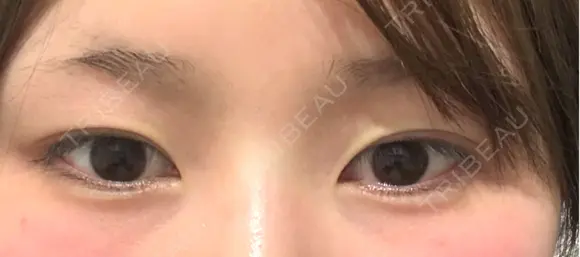 二重埋没 湘南美容クリニック 千葉センシティ院 BEFORE メイン用