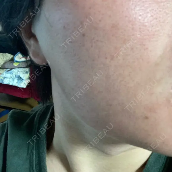 その他（肌） ルラ美容クリニック 大阪本院 BEFORE メイン用