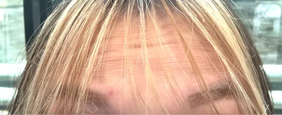 ボトックス（眉間） / ボトックス（額） ルラ美容クリニック 渋谷本院 BEFORE メイン用