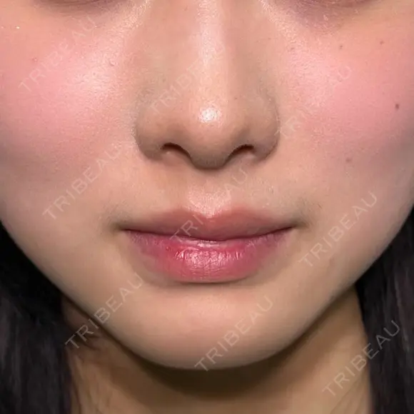 ヒアルロン酸注入（涙袋） / ヒアルロン酸注入（鼻） / ヒアルロン酸注入（あご） / ボトックス（エラ・小顔） / ヒアルロン酸注入（唇） / ヒアルロン酸注入（頬） HAAB×DREAM BEAUTY CLINIC 大阪梅田院 BEFORE メイン用