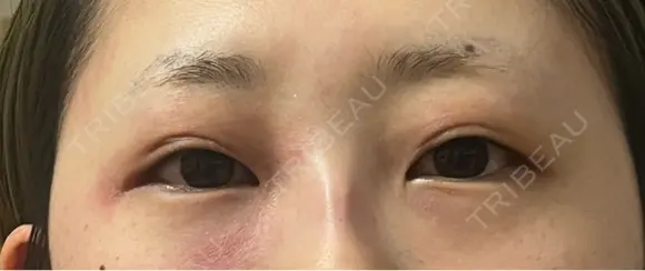 ヒアルロン酸注入（涙袋） ルラ美容クリニック 宇都宮院 BEFORE メイン用