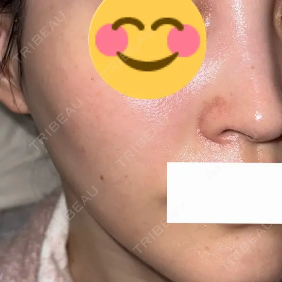 ピコスポット G MEDICAL ART クリニック 新宿院 BEFORE メイン用