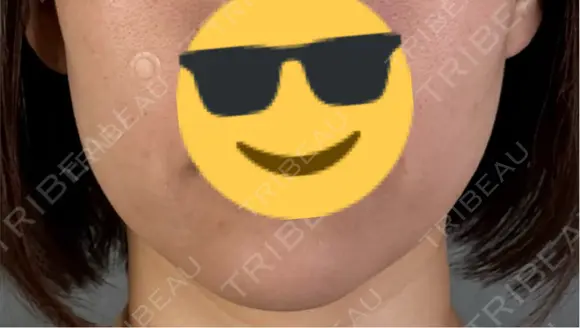 糸リフト アリエル美容クリニック 郡山院 BEFORE メイン用