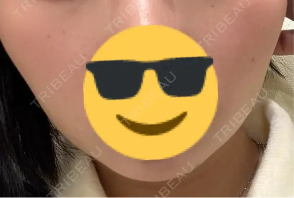 ボトックス（エラ・小顔） 共立美容外科 梅田院 BEFORE メイン用