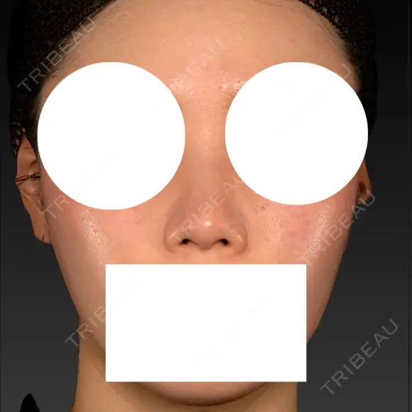 隆鼻術 / 鼻尖形成（切開） / 軟骨移植 / 鼻中隔延長（非切開） X CLINIC 大阪院 BEFORE メイン用