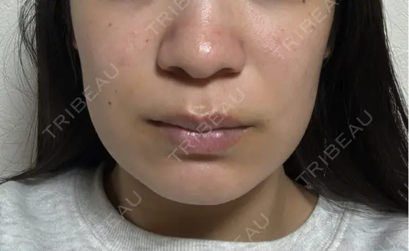 イオン導入 / 毛穴洗浄（ハイドラフェイシャルなど） ルラ美容クリニック 宇都宮院 BEFORE メイン用