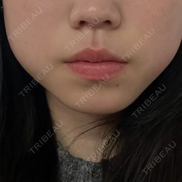 ボトックス（エラ・小顔） ルラ美容クリニック 京都院 BEFORE メイン用