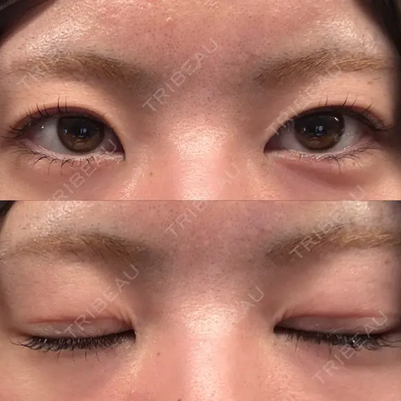 二重埋没 形成外科と美容外科のクリニック池袋 BEFORE メイン用