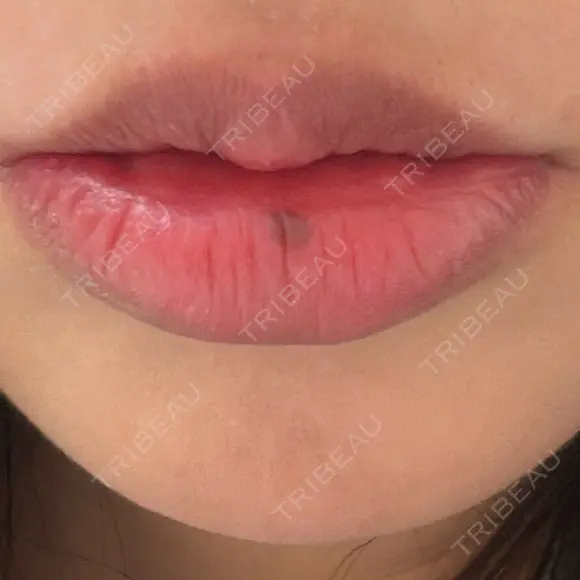 その他（口元） ルラ美容クリニック 大阪心斎橋院 BEFORE メイン用