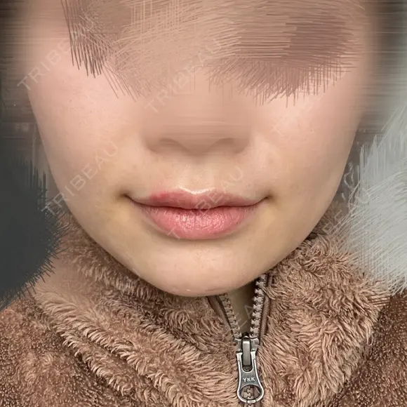 ボトックス（エラ・小顔） / RF（高周波）たるみ治療 大美会クリニック 梅田院 BEFORE メイン用