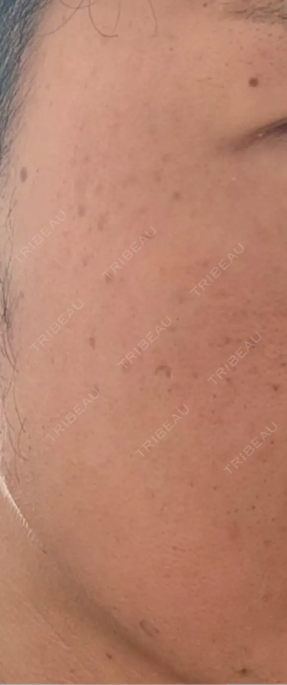 毛穴洗浄（ハイドラフェイシャルなど） / ニードルRF（ポテンツァなど） / ポテンツァ A CLINIC（エークリニック） 新宿院 BEFORE メイン用