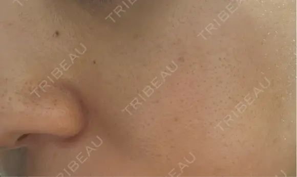 医療脱毛（顔） ON-CLINIC Beauty BEFORE メイン用