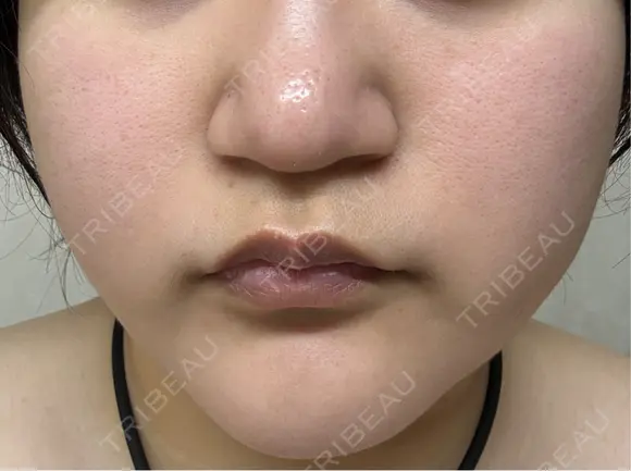 医療脱毛（顔） 東京シルククリニック 東京神田院 BEFORE メイン用