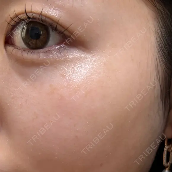 ピーリング（ニキビ・毛穴） / ピーリング（ハリ・ツヤ） / ルメッカ ハナビューティークリニック BEFORE メイン用