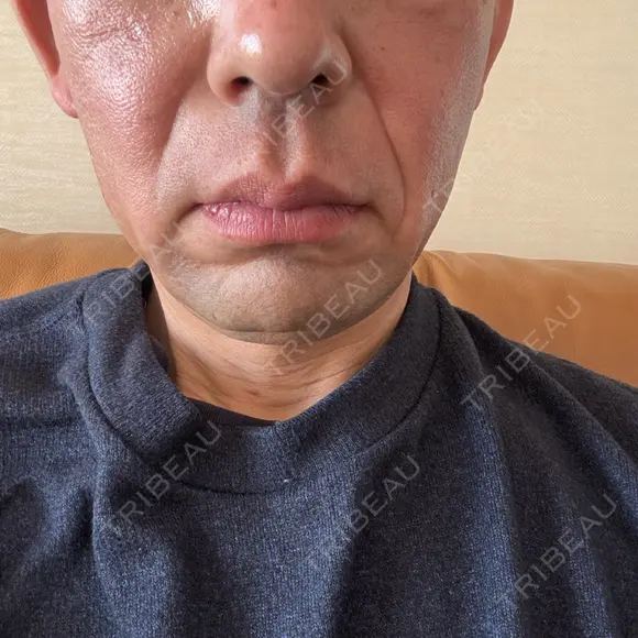 RF（高周波）たるみ治療 plume clinic BEFORE メイン用