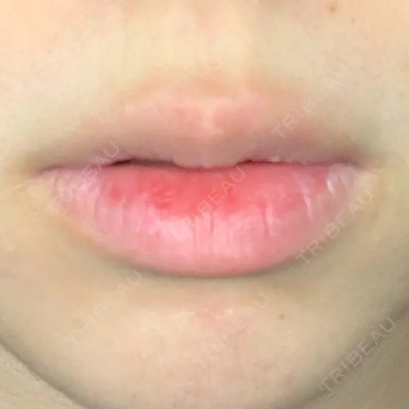 口唇縮小術 / PRP皮膚再生療法 品川美容外科 品川院 BEFORE メイン用