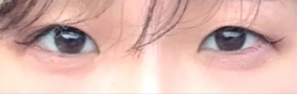 眼瞼下垂（切開） 聖心美容クリニック 六本木院 BEFORE メイン用