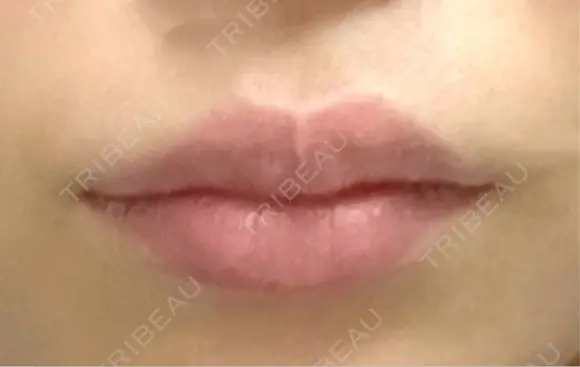 口唇縮小術 博多美容外科/美容皮膚科 ビラビューティークリニック BEFORE メイン用
