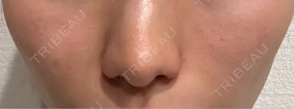 ヒアルロン酸注入（頬） Wi Clinic （ウィ クリニック）心斎橋院 BEFORE メイン用