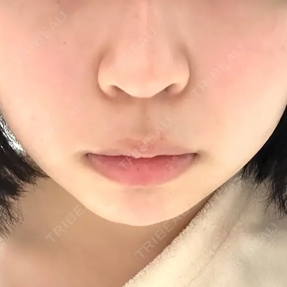 ヒアルロン酸注入（あご） / ボトックス（エラ・小顔） / ヒアルロン酸注入（唇） / ボトックス（口角） ルラ美容クリニック 大阪本院 BEFORE メイン用