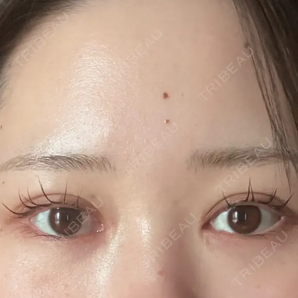 ヒアルロン酸注入（涙袋） / ほくろ・いぼ除去レーザー（肌） プライベートスキンクリニック 梅田本院 BEFORE メイン用