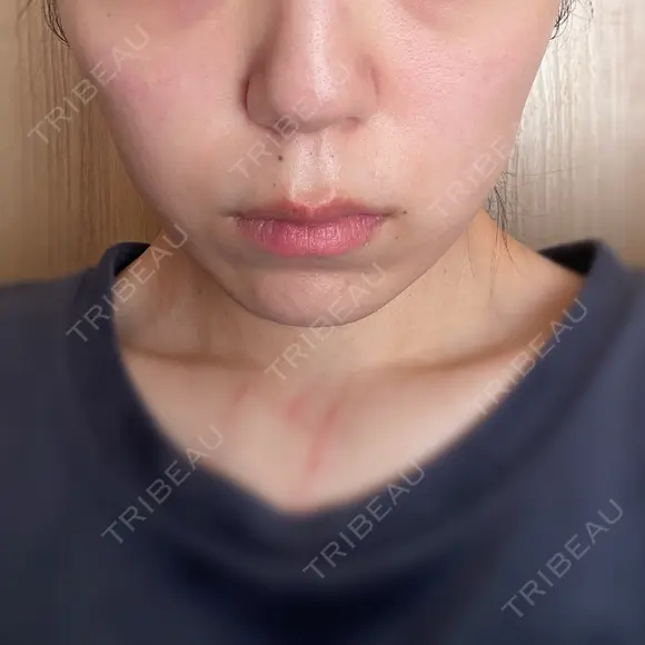 インモード TUNE CLINIC【チューンクリニック】 BEFORE メイン用