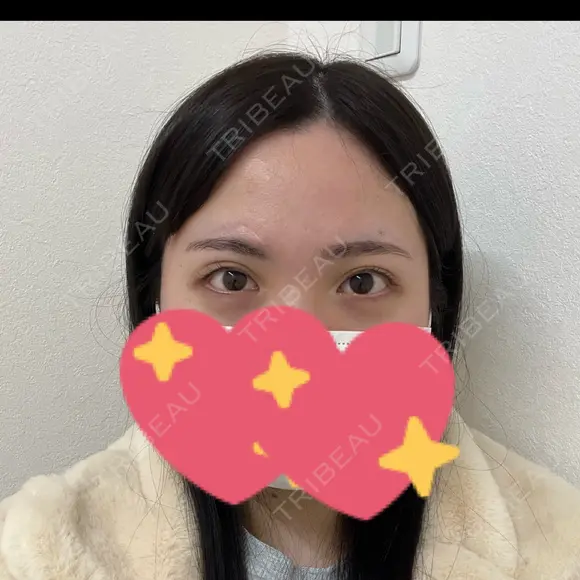 二重切開 / 眼瞼下垂（切開） / 目尻切開 / タレ目形成・グラマラスライン（切開） eクリニック 福岡院 BEFORE メイン用