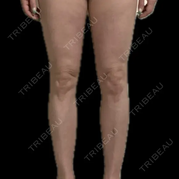 脂肪吸引（脚） / 脂肪吸引（お尻） / 脂肪吸引（腰） GAYA body design clinic BEFORE メイン用